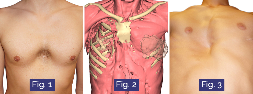 Images de Pectus arcuatum, Pectus/Poland hybride et échec de Nuss