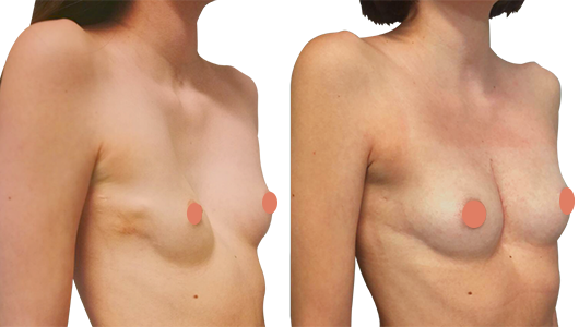 Picture of a woman's Nuss redo (Concave chest treatment)