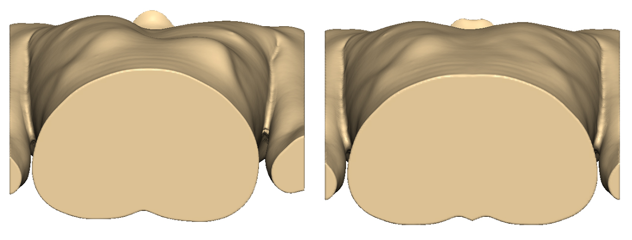 Before/after images of the patient chest treated with 3D custom-made implants