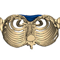 3D view of a type 1 Pectus Excavatum with implant