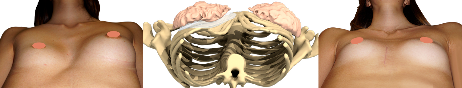 Foto prima/dopo del sollevamento del pectus in una donna con un impianto 3D