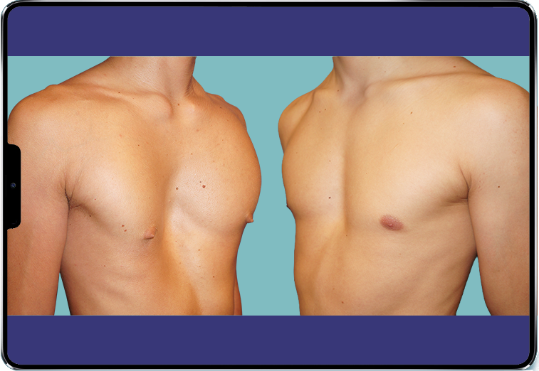 Severe pectus vs. mild pectus Comparison between a photo of a severe pectus and a mild pectus
