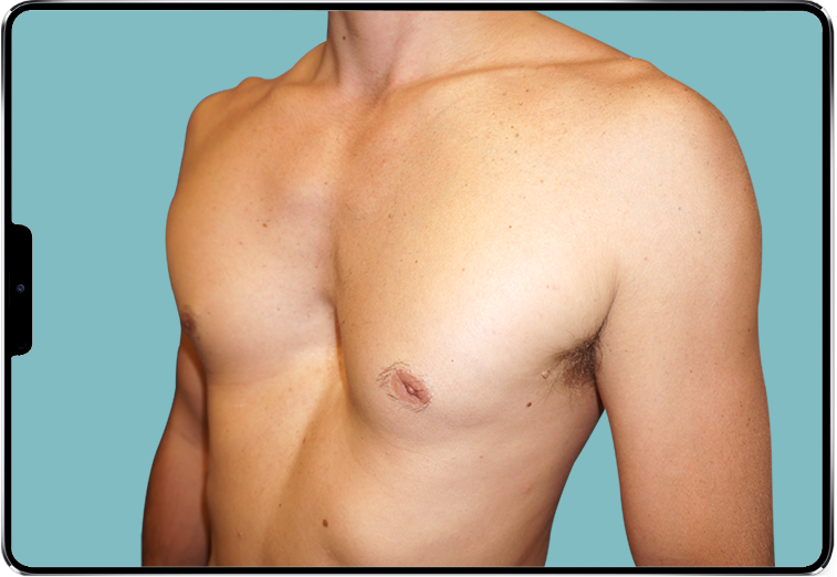 Image d'un Pectus Excavatum profond d'homme Image d'un Pectus Excavatum profond d'homme