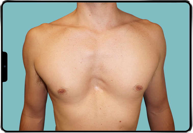 Image d'un Pectus Excavatum profond d'homme Image d'un Pectus Excavatum profond d'homme