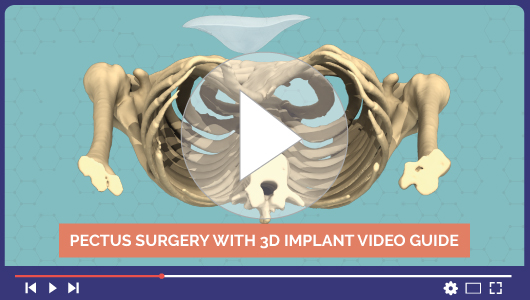 Video dell'intervento chirurgico al petto escavato con un impianto 3D personalizzato