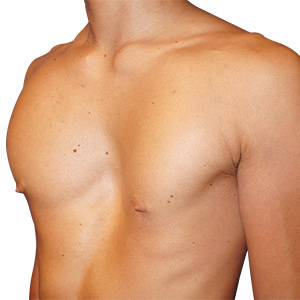 Type 3 Pectus Excavatum