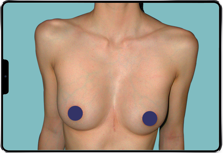 Image d'un Pectus Excavatum profond de femme traité par implant 3D sur-mesure Image d'un Pectus Excavatum profond de femme traité par implant 3D sur-mesure