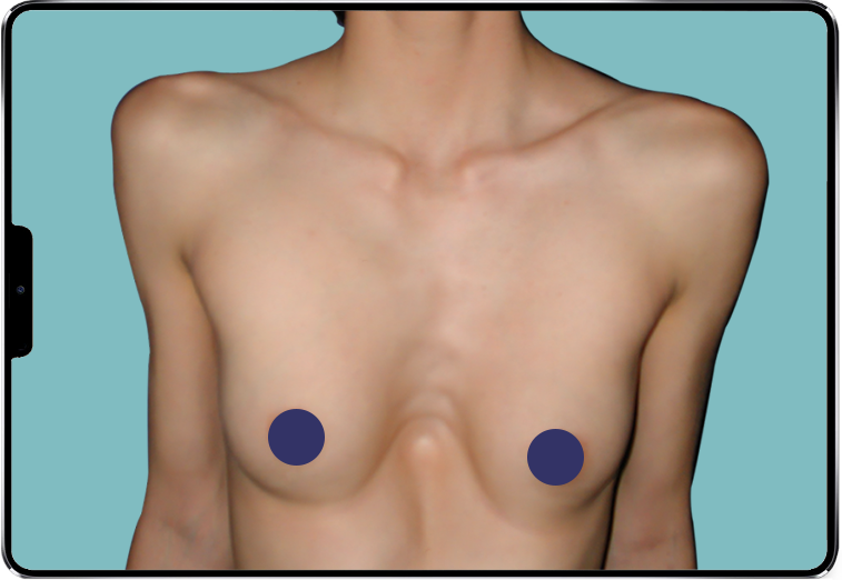 Image d'un Pectus Excavatum profond de femme Image d'un Pectus Excavatum profond de femme