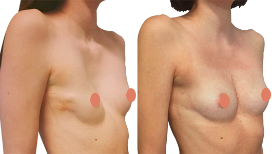 Photo Avant/Après d'une opération de Pectus Excavatum femme