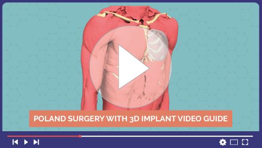 Video dell'intervento chirurgico alla Sindrome di Poland con impianto 3D personalizzato
