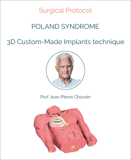 Surgery protocol for Poland Syndrome with implant technique