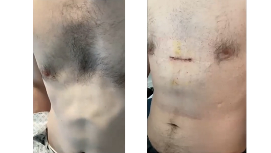 Resultado de cirugía secundaria de pectus excavatum con implantes 3D tras fracaso del procedimiento de Ravitch
