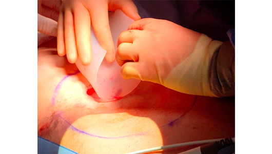 Inserción del implante 3D en el bolsillo durante la cirugía de Pectus