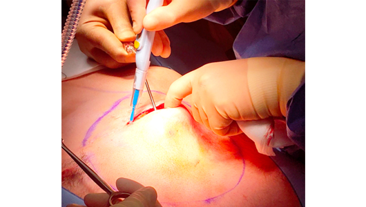 Einschnitt der Brusthaut während einer Pectus-Operation