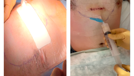 Wound therapy after Pectus surgery and seroma puncture