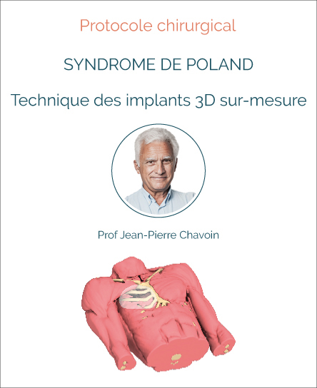 Protocole chirurgie syndrome de Poland avec implant