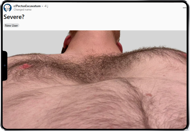 Reddit post about pectus excavatum severity Screenshot of a Reddit post from the r/Pectusexcavatum subreddit showing a user asking how severe their pectus is