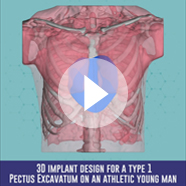 Pectus Excavatum surgery with implant video Pectus Excavatum surgery with implant technique video