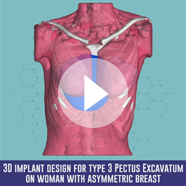 Pectus Excavatum surgery with implant video Pectus Excavatum surgery with implant technique video