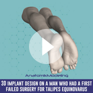 Pectus Excavatum surgery with implant video Pectus Excavatum surgery with implant technique video