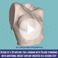 Pectus Excavatum surgery with implant video Pectus Excavatum surgery with implant technique video