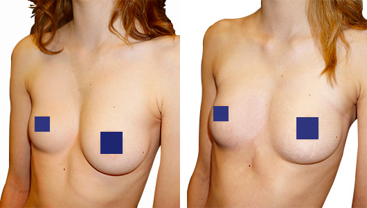 Resultado antes/después de la corrección de asimetría mamaria y de Pectus con un implante