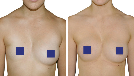 Before and after result of a corrected Pectus Excavatum on a breast asymmetry