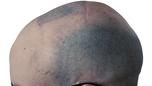Imagen de un cráneo reconstruido mediante craneoplastia