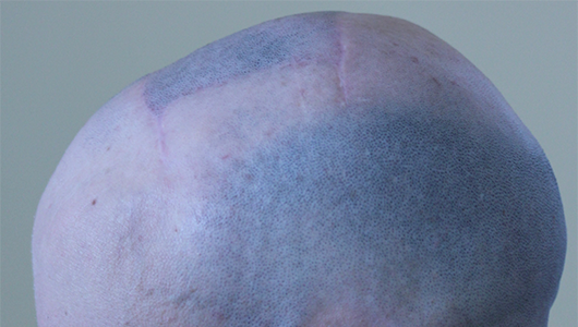 Vista del cráneo de un paciente tratado con un implante a medida