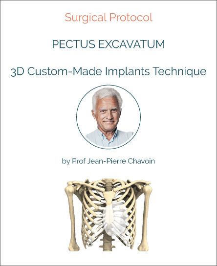 Surgery protocol for Pectus Excavatum with implant technique