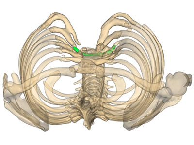 Thorax en 3D montrant l'emplacement du tube contenant le filet de prolène, vue en défilé