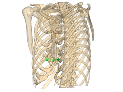 Thorax en 3D montrant l'emplacement du tube contenant le filet de prolène, vue en 3/4