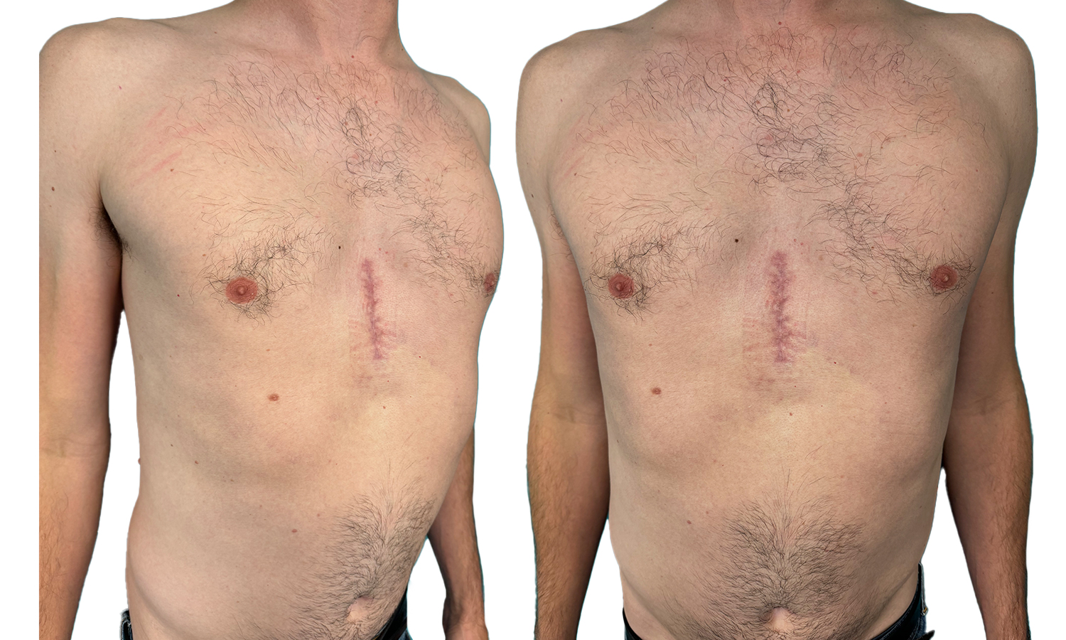 Result treatment Pectus Excavatum type 1