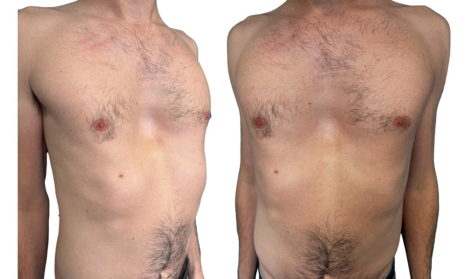 Pectus Excavatum type 1