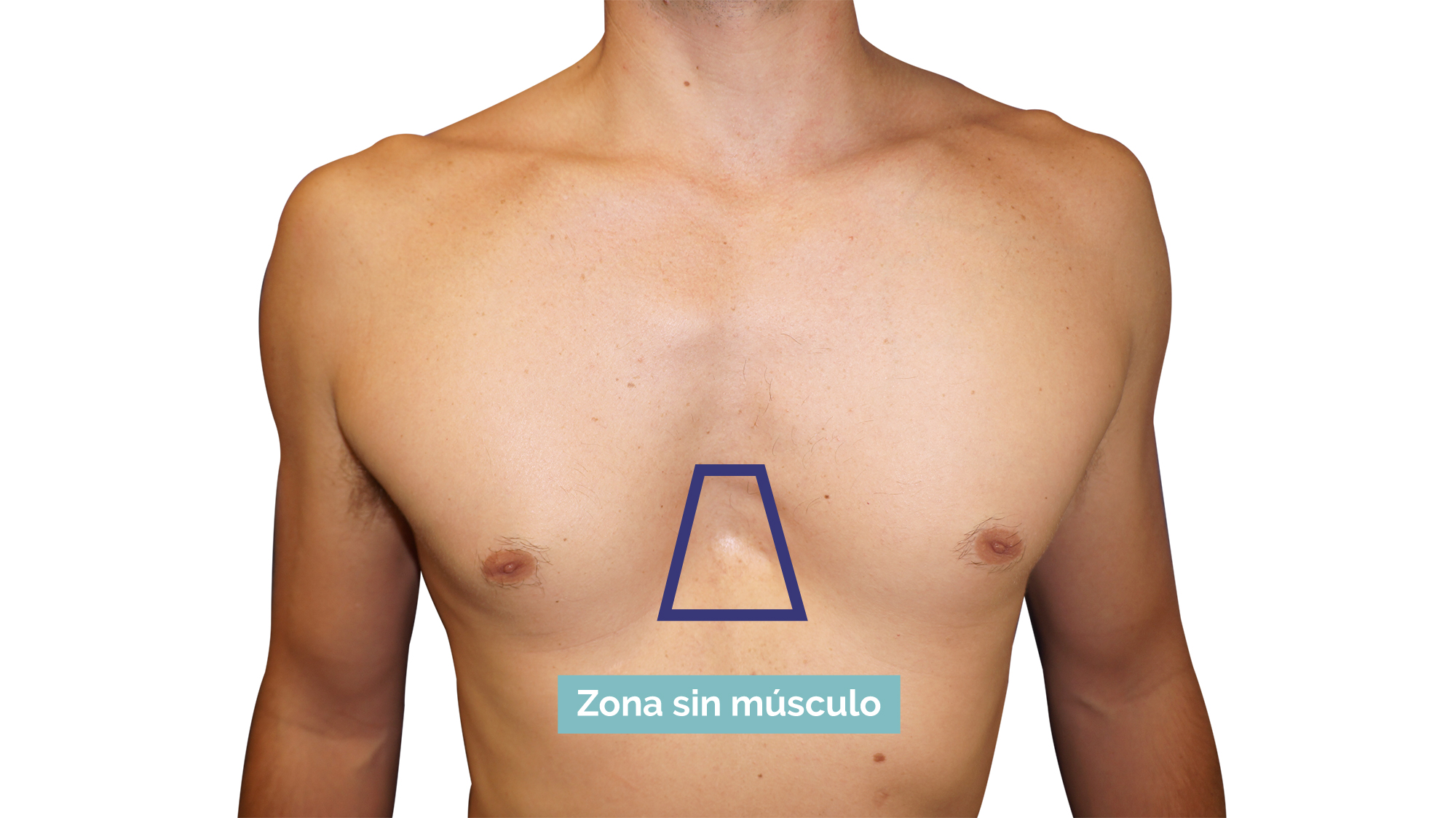 Imagen de un Pectus Excavatum, zona sin músculo Imagen de un Pectus Excavatum, zona sin músculo