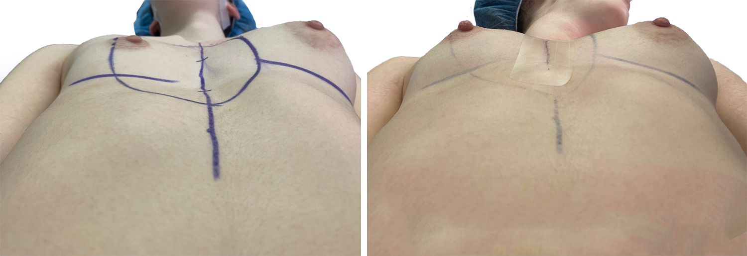 Before/after picture of a woman’s pectus, perOp