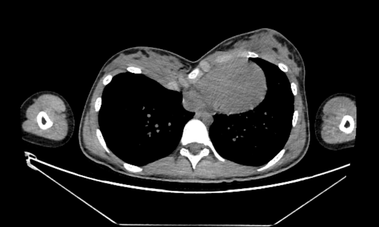 CT Scan of the Funnel Chest of a woman