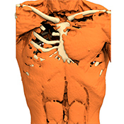 Typologie Des Poland Syndroms Anatomikmodeling