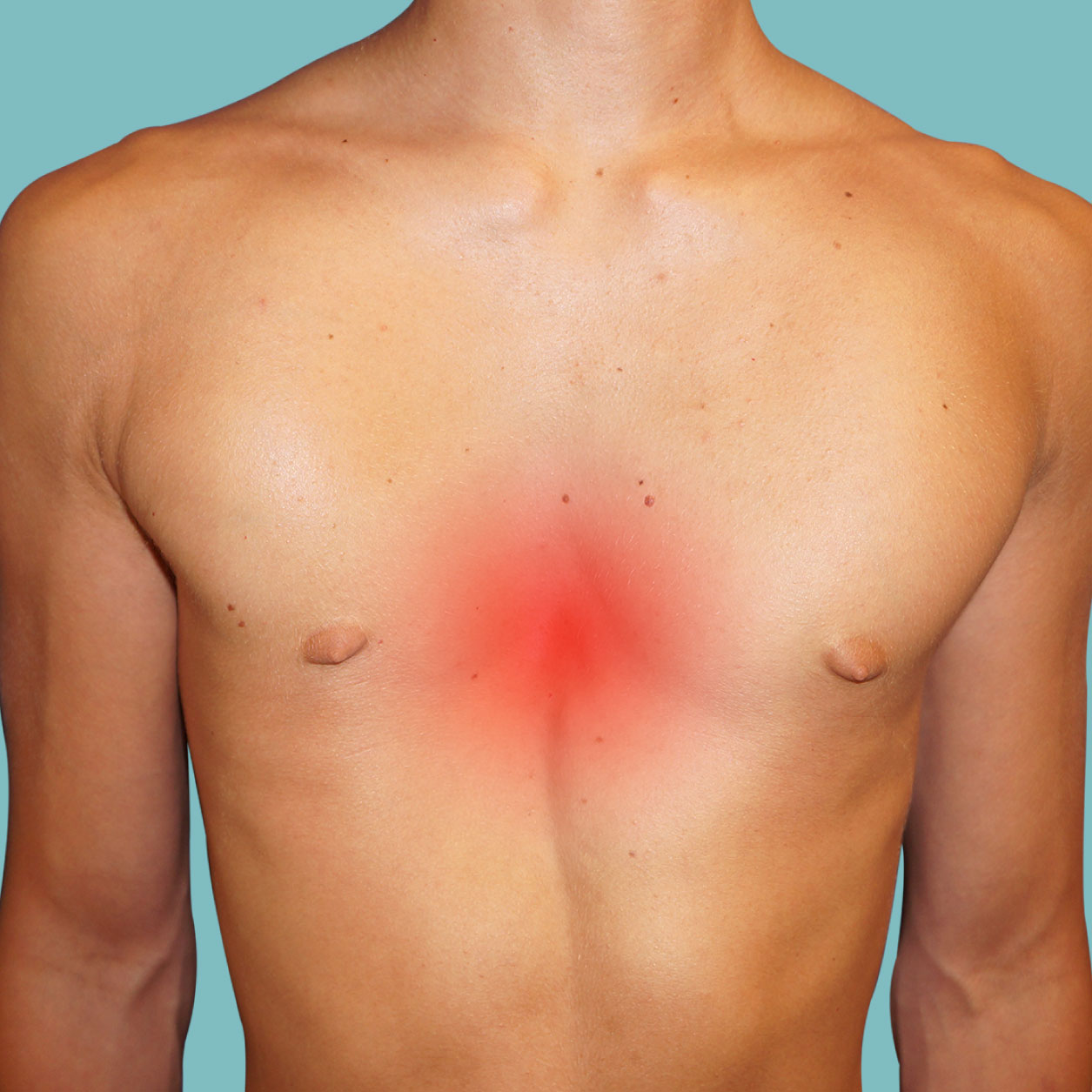 Avoir un pectus excavatum est-il grave ?