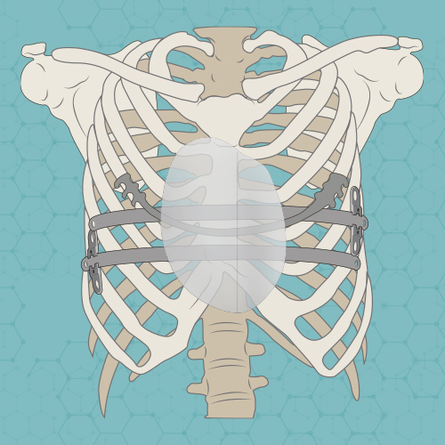 Nuss Ravitch or Implants for Pectus surgery?