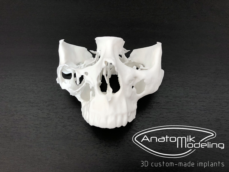 3D printing : New approach for pre surgery planning 
