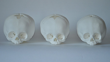 3D printing: New way of training for the skull examination 
