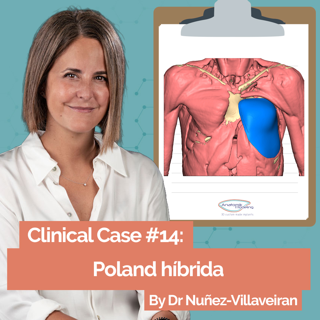 Caso clínico: Secuencia híbrida de Poland tipo 4M con pectus arcuatum asociado – reconstrucción CAD-3D