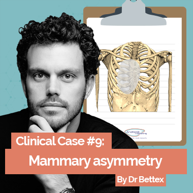 Clinical case 9: mammary asymmetry corrected by Pectus implants