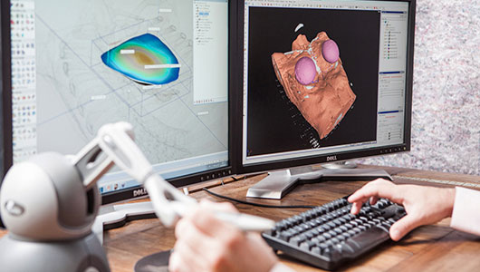 Progettazione assistita da computer di un impianto Pectus Excavatum