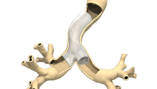 3D Custom-Made Airway Stent | AnatomikModeling 3D Custom-Made Airway Stent | AnatomikModeling