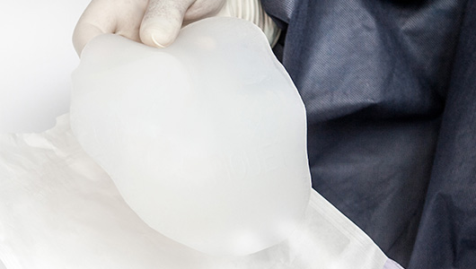 Surgeon holding a 3D implant for Pectus Excavatum correction