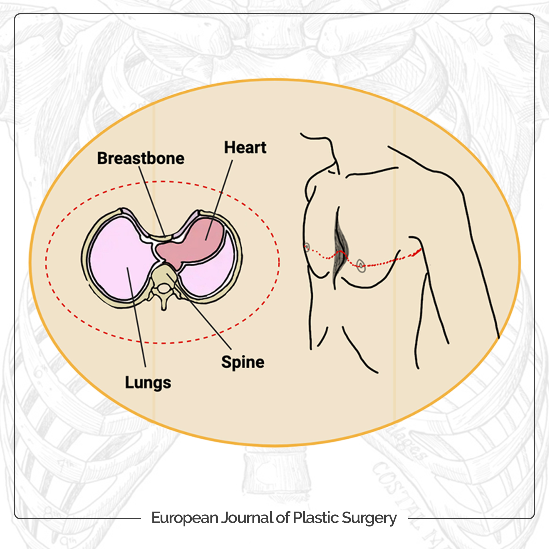 New publication: The evolution of surgical strategies for chest wall deformities with digital planning and custom implants: a narrative review