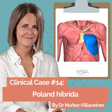 Clinical case: Hybrid sequence for type 4M Poland syndrome with associated pectus arcuatum