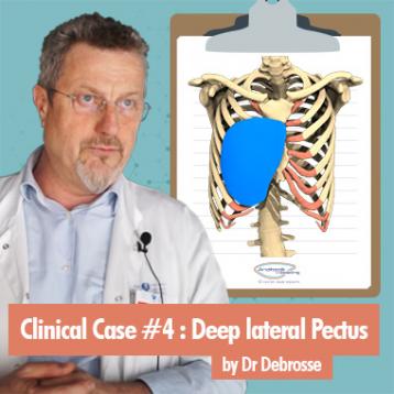 Clinical case : Deep lateral Pectus by Dr Debrosse